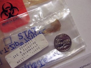 Knee meniscus with quarter (Custom).jpg